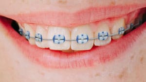 10+ Light Force Braces