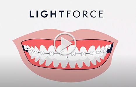 Lighforce Video Cover Image Orthodontic Specialists of St. Louis
